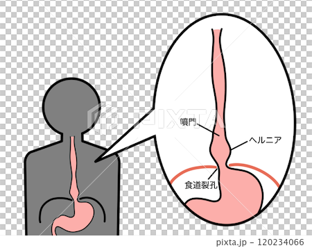 食道裂孔ヘルニア 滑脱型 文字あり 食道裂孔ヘルニア 滑脱型 文字あり 120234066