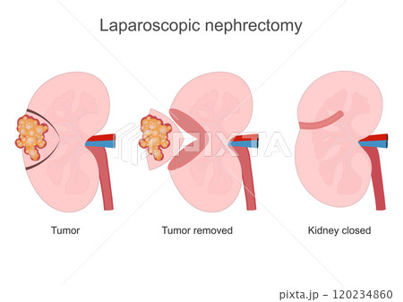 Nephrectomy is a major procedure performed. Nephrectomy is a major procedure performed. 120234860