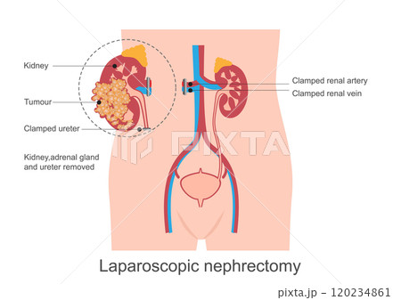 Nephrectomy is the surgical removal of a kidney. 120234861