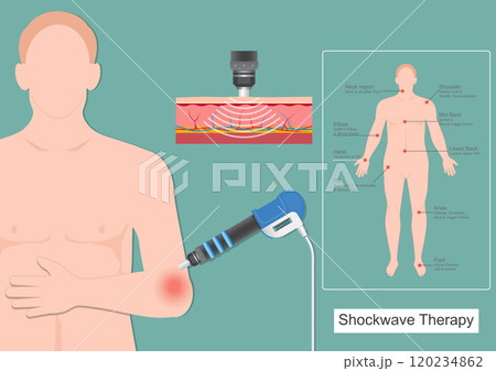 Shockwave therapy for tennis elbow (lateral epicondylitis) Shockwave therapy for tennis elbow (lateral epicondylitis) 120234862