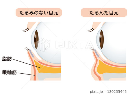 目の下のたるみ　たるみのない目元と、たるんだ目元 120235443