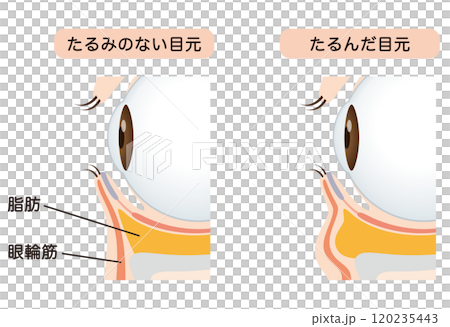 目の下のたるみ　たるみのない目元と、たるんだ目元 120235443