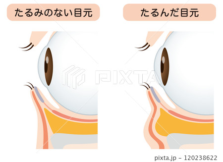 目の下のたるみ　たるみのない目元と、たるんだ目元 120238622