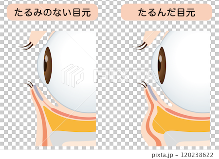 目の下のたるみ　たるみのない目元と、たるんだ目元 120238622