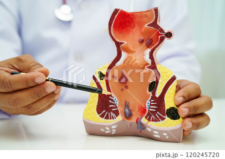 Asian doctor with rectum and hemorrhoid human anatomy model at hospital, inflamed vascular structure. 120245720