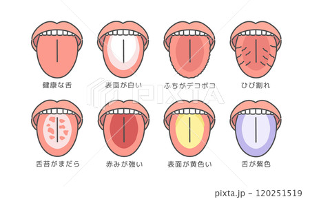 舌の健康状態　種類　イラストセット（説明あり） 120251519