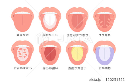 舌の健康状態　種類　イラストセット（説明あり） 120251521