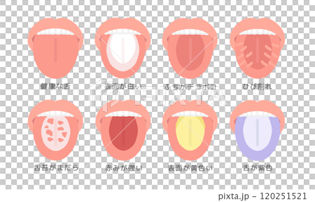 舌頭健康狀態類型插圖集(附說明) 舌頭健康狀態類型插圖集(附說明) 120251521