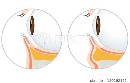 目の下のたるみ　たるみのない目元と、たるんだ目元 120262131