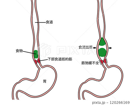 食道疾患　食道アカラシア　文字あり 120266169