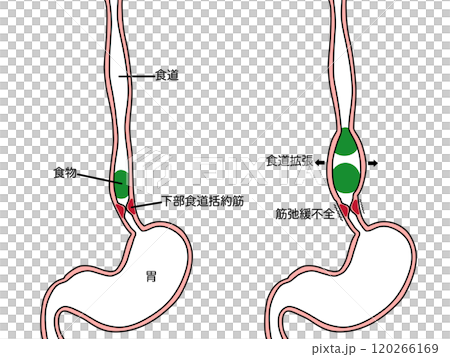食道疾患　食道アカラシア　文字あり 120266169