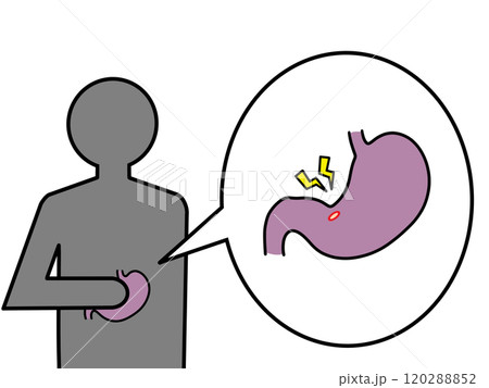 胃潰瘍による胃痛 胃潰瘍による胃痛 120288852