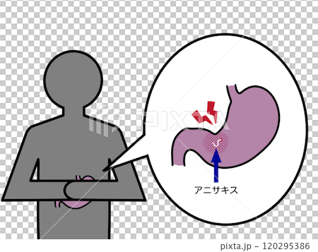 胃異尖線蟲病引起的腹痛(附文字) 胃異尖線蟲病引起的腹痛(附文字) 120295386