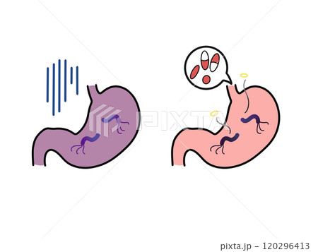 ピロリ菌に感染した胃と除菌している胃 ピロリ菌に感染した胃と除菌している胃 120296413