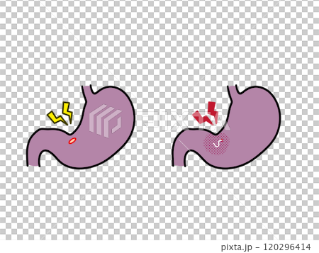 Gastric ulcers and gastric anisakiasis 120296414