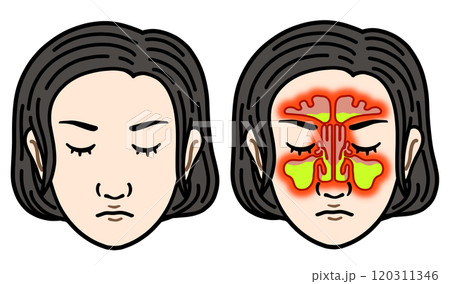 副鼻腔炎(アジア人女性) 副鼻腔炎(アジア人女性) 120311346