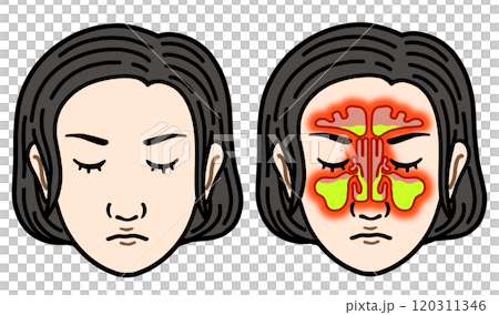 副鼻腔炎(アジア人女性) 副鼻腔炎(アジア人女性) 120311346