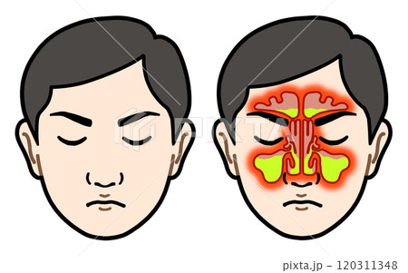 副鼻腔炎（アジア人男性） 120311348