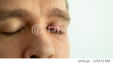 Selective focus on swollen and painful red upper eye lid with onset of stye infection due to clogged oil gland and staphylococcal bacteria. Close up right upper eyelid abscess. 120311368