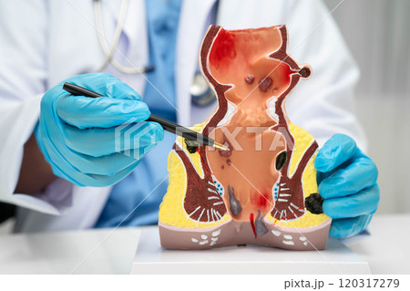 Asian doctor with rectum and hemorrhoid human anatomy model at hospital, inflamed vascular structure. 120317279
