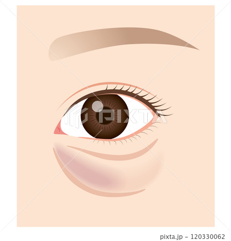 目の下のたるみ　たるんだ下まぶた 120330062