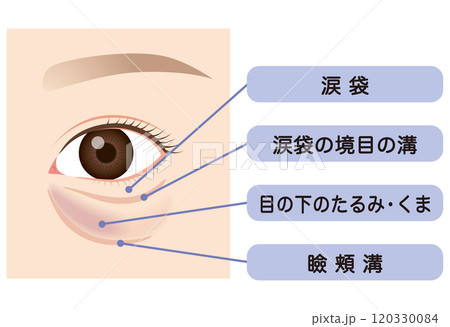 目の下のたるみ　たるんだ下まぶた 120330084