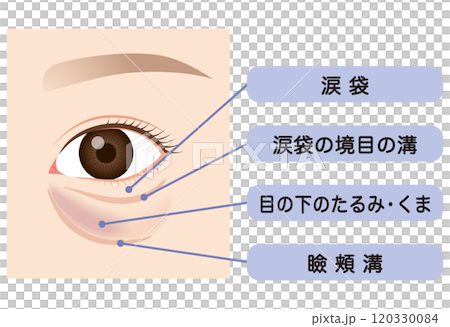 目の下のたるみ　たるんだ下まぶた 120330084