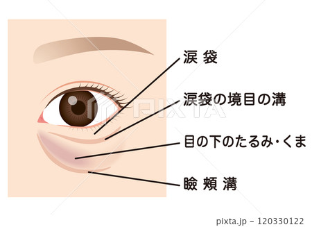 目の下のたるみ　たるんだ下まぶた 120330122