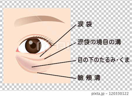 目の下のたるみ　たるんだ下まぶた 120330122