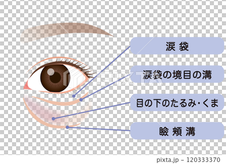 眼袋、下眼瞼下垂 120333370