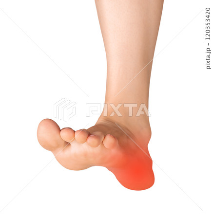 foot with a painful heel, isolated on a white background. Medical concept highlighting injury, 120353420