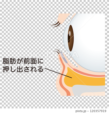 眼袋、下眼瞼下垂 120357919