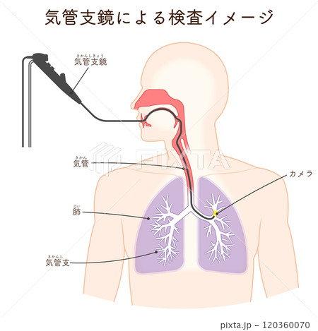 気管支鏡による肺がん検査のイラスト、Bronchoscopy 120360070