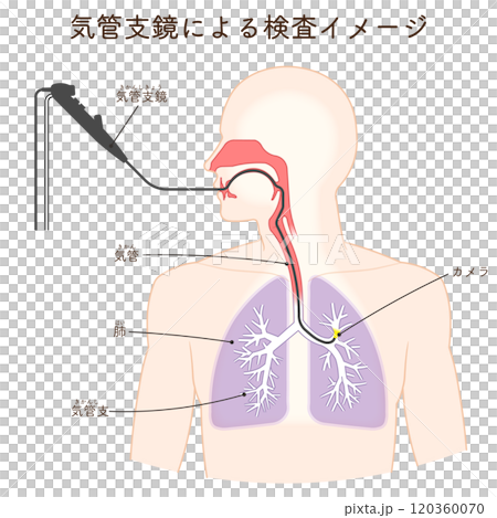 気管支鏡による肺がん検査のイラスト、Bronchoscopy 120360070