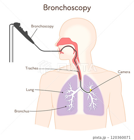 気管支鏡による肺がん検査のイラスト、Bronchoscopy 120360071