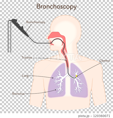 気管支鏡による肺がん検査のイラスト、Bronchoscopy 120360071