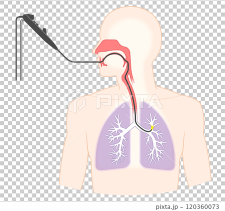 Illustration of lung cancer examination using a bronchoscope, Bronchoscopy Illustration of lung cancer examination using a bronchoscope, Bronchoscopy 120360073