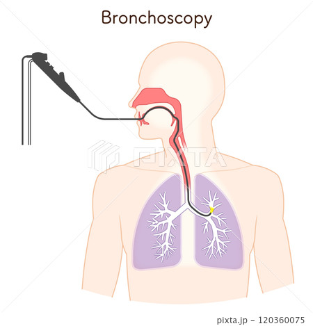 気管支鏡による肺がん検査のイラスト、Bronchoscopy 120360075