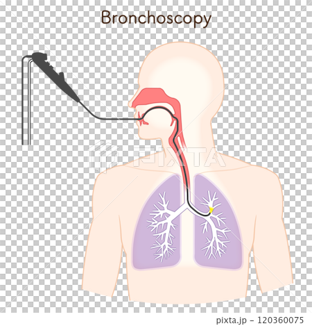 気管支鏡による肺がん検査のイラスト、Bronchoscopy 120360075