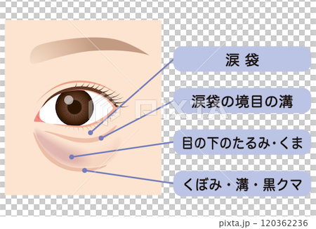 目の下のたるみ　たるんだ下まぶた 120362236