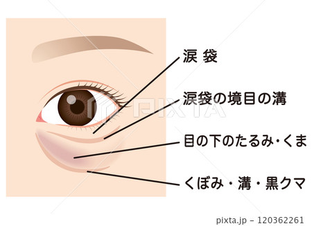 目の下のたるみ　たるんだ下まぶた 120362261