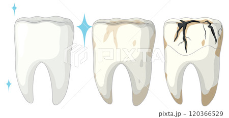 Stages of Tooth Decay Illustration 120366529