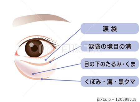 目の下のたるみ たるんだ下まぶた 目の下のたるみ たるんだ下まぶた 120399319