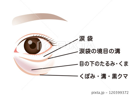 目の下のたるみ　たるんだ下まぶた 120399372