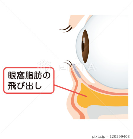 目の下のたるみ　たるんだ下まぶた 120399408
