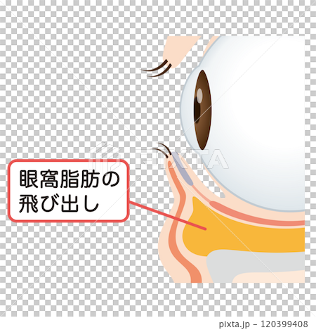 眼袋、下眼瞼下垂 眼袋、下眼瞼下垂 120399408