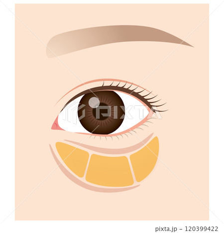 眼窩脂肪 目の下のたるみ たるんだ下まぶた 眼窩脂肪 目の下のたるみ たるんだ下まぶた 120399422