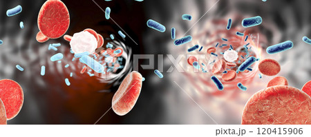Bacteria in blood, bacteriemia Bacteria in blood, bacteriemia 120415906