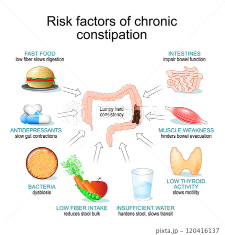 Chronic constipation. 120416137