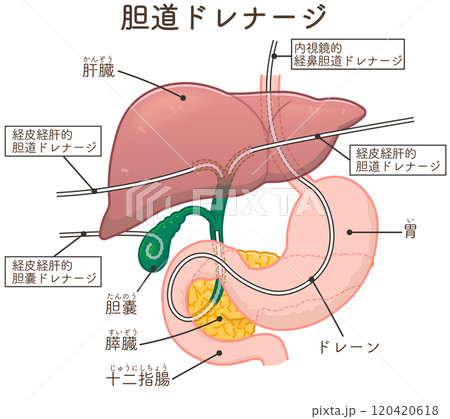 胆道ドレナージのイラスト、Biliary Drainage 胆道ドレナージのイラスト、Biliary Drainage 120420618